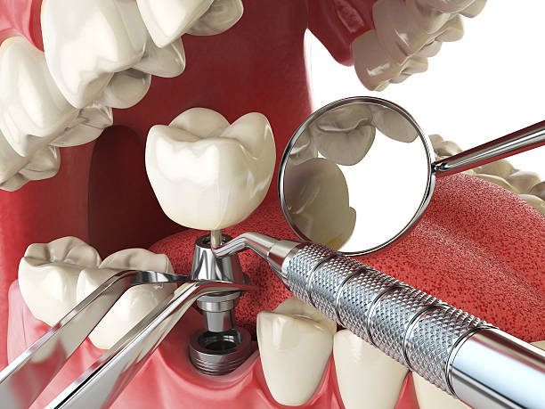 Best Emergency Root Canal Treatment in Napavine, WA